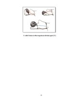 Referāts 'Skolioze', 13.