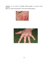 Konspekts 'Ginekoloģiskās infekcijas saslimšanas', 19.